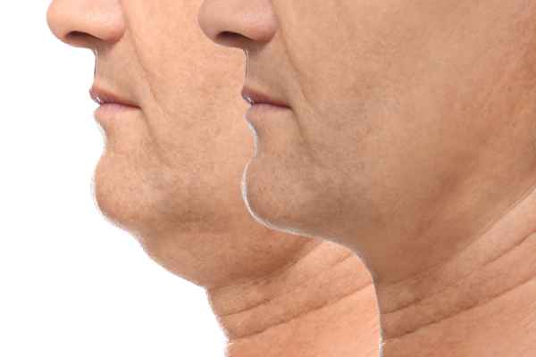 HIFU - Breakthrough in Anti - ageing 2 hifu results Haverhill