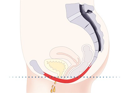 Pelvic-Floor Muscle Repair 5 Pelvic floor muscles Haverhill