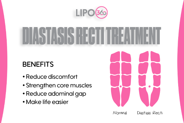 Revolutionising Muscle Repair: The Power of LIPO360 Body Sculpt Post-Injury 5 diastasis recti treatment Haverhill