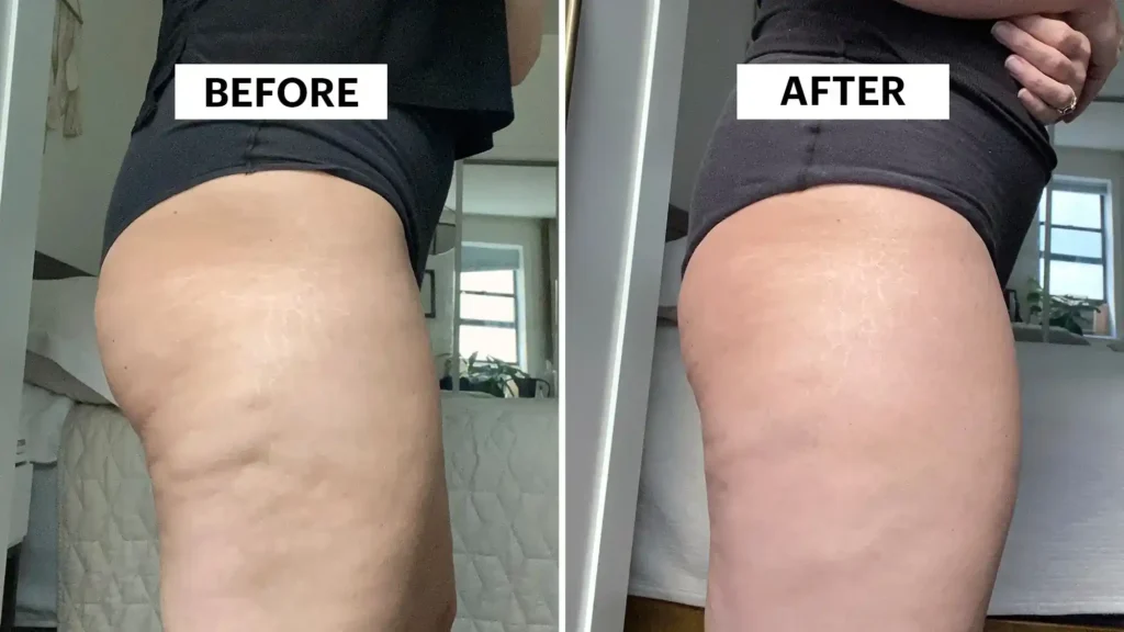 Do Toning Exercise Haverhill Really Tackle Cellulite?