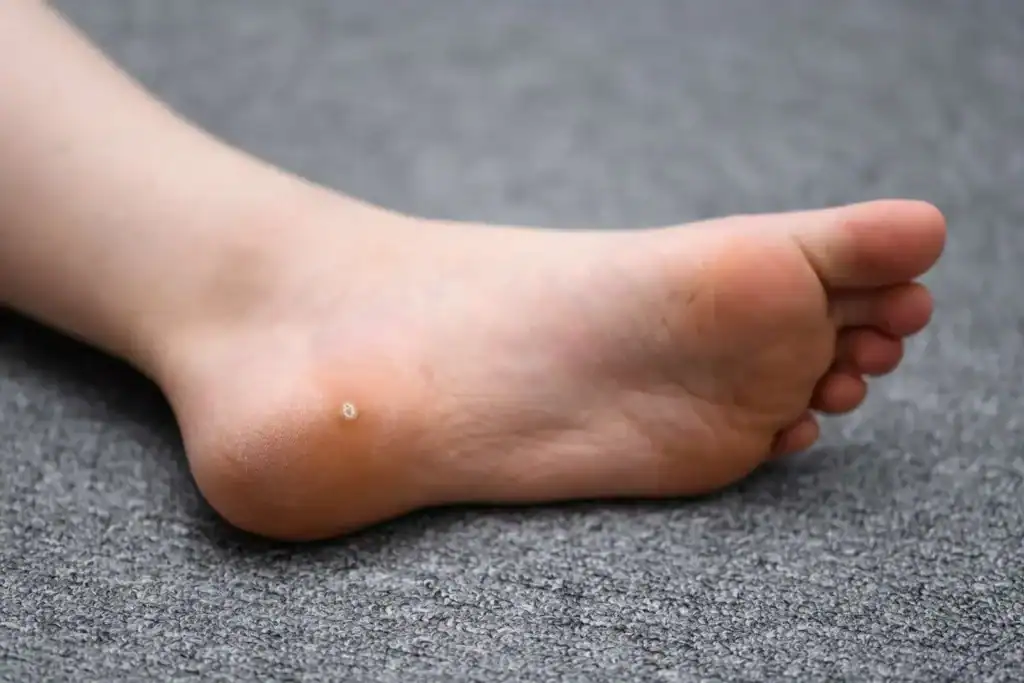 Cryotherapy For Warts And Also Verrucas 2 Image of verruca on the bottom of the foot that able to be treated with Cryotherapy Haverhill