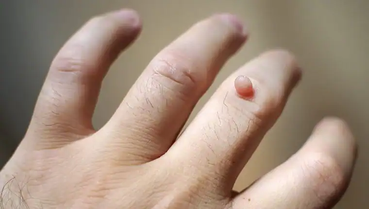 Image of blemish that Cryotherapy Haverhill can remove with Lipo 360.