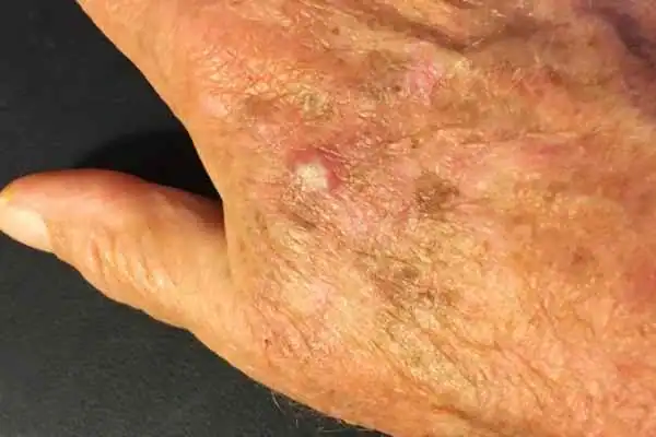 Image of Actinic keratoses Haverhill on a person hand