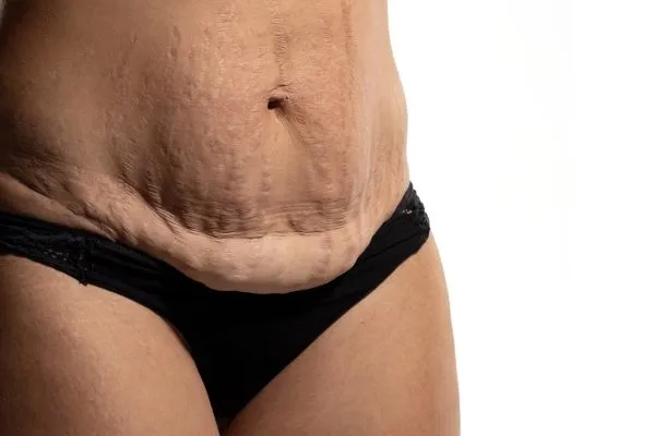The science behind skin tightening Haverhill picture of a woman's sagging skin on the stomach